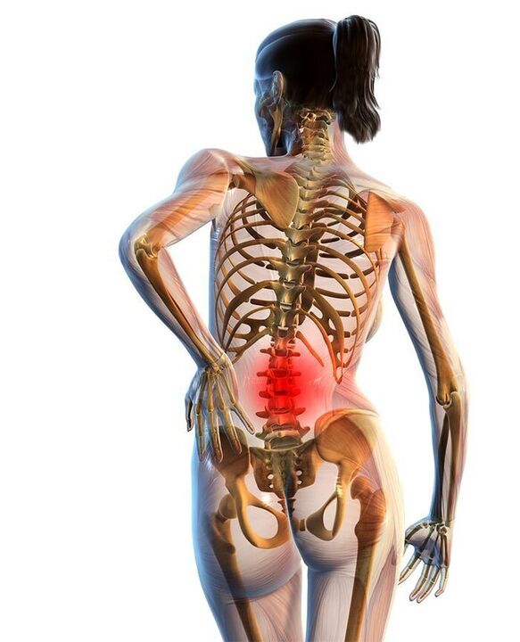 Dažniausiai pasitaiko stuburo juosmeninės dalies osteochondrozė