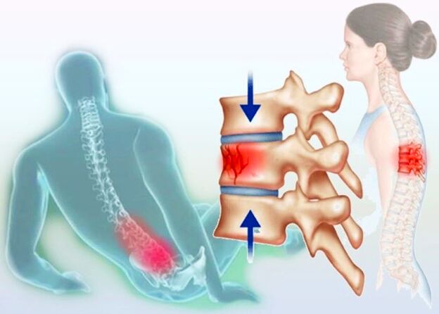 Netgi įprasta trauma gali sukelti osteochondrozės vystymąsi