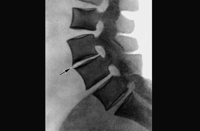 Krūtinės ląstos stuburo osteochondrozės apraiškos rentgeno nuotraukoje